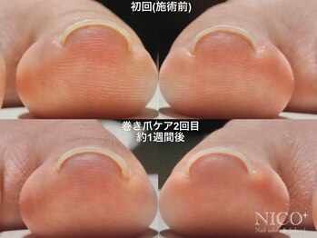 ニコプラス(NICO+)/巻き爪ケア