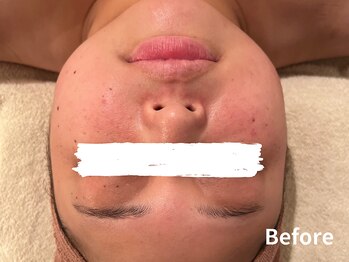 ダイヤモンド リーエンダ(Diamond leende)/クレイハーブピーリング