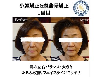 RKY/小顔矯正&頭蓋骨矯正1回 (70代)