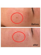 シェリモ(CHERIMO)/シミケア3回目の結果