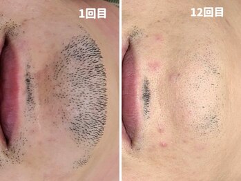 エイプリルプラス(April plus)/ヒゲ脱毛