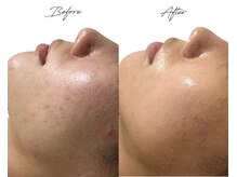 ビズビズ 梅田店(bisebise)/梅田ハーブピーリング/ニキビ