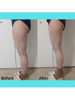 ホワイトビューティーラボ(White Beauty Lab)/足脂肪冷却