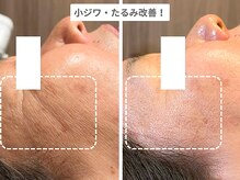 アンシャンテ 神戸元町店(Enchante)/毛穴洗浄ピーリングフェイシャル