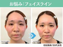 ナチュラルビューティーフェイス 横浜(NBF)/フェイスライン / 20代