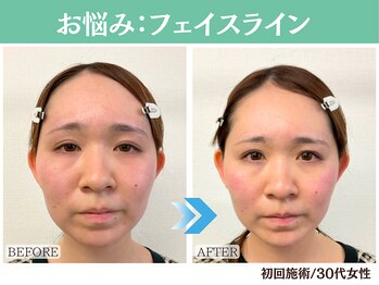 ナチュラルビューティーフェイス 横浜(NBF)/フェイスライン / 20代/横浜小顔