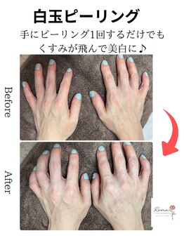 ローマサロン/手に白玉ピーリング1回で美白♪