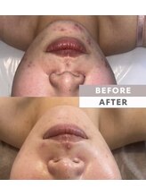 アトリエリン 小牧本店(Atelier Rin)/REVIハーブピーリング