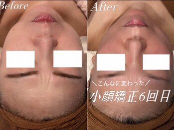 アイラブワン(eye love one)/小顔矯正【小顔/毛穴/こり】