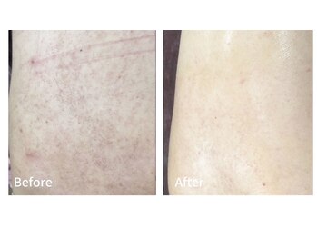 ココ 千里丘(Cocoh)/《背中》ピーリング