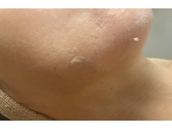 ブリリアンス(BRILLIANCE)/ターンオーバーを正常に★