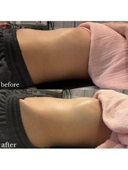 ウェルフォーセルフ(WELL FOR SELF)/高周波＋筋膜リリース