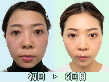 ナチュラルパーフェクトフェイス 新宿/３０代・左右差、歪み／新宿小顔