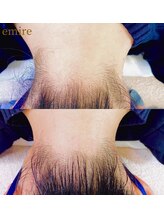 エミレ(emire)/うなじワックス脱毛