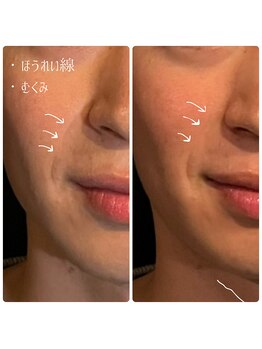 クク 赤坂 天神(99 KUKU)/【メンズ】【ほうれい線】