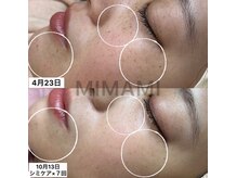 ミナミ(MINAMI)/シミケア1回で結果出し