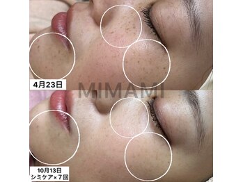 ミナミ(MINAMI)/シミケア1回で結果出し