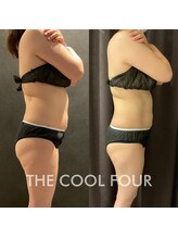 クライオ360(Cryo360)/脂肪冷却ビフォーアフター