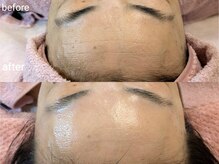 シャリル(charire)/おでこのシワ改善