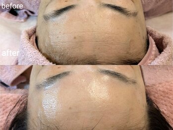 シャリル(charire)/おでこのシワ改善