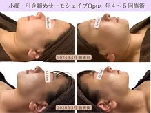 ラエッセ(La Esse)/年に数回施術で別人級に？！