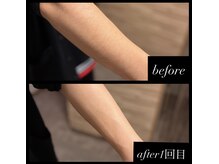 メンズスタイル(MEN'S STYLE)の雰囲気（腕脱毛　清潔感up）