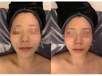 ナラビューティー(NARA BEAUTY)/コルギ1回効果