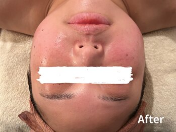 ダイヤモンド リーエンダ(Diamond leende)/クレイハーブピーリング