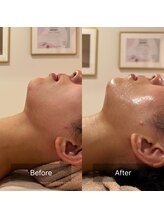 アラマンダ(Allamanda)/顎下BeforeAfter