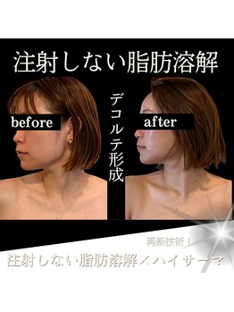 クリニカルボーテ 心斎橋院(CLINICAL BEAUTE)/小顔はデコルテから作る！