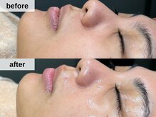 アルムボーテ 代官山 恵比寿(ARUIM Beaute)/シェービングビフォーアフター