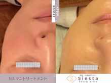 シエスタ(siesta)/セルマン艶玉肌トリートメント