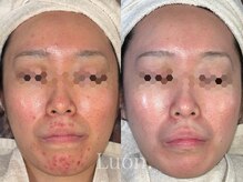 ルオン(Luon.)の雰囲気(痛い思いは一切なしで肌に優しくニキビ改善!〈ニキビケア〉)