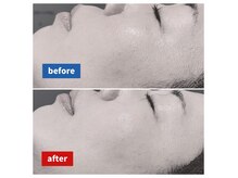 フェイシャル1回の効果。なによりも継続が大切です★☆