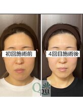 キュープ 浜松店(Qpu)/左右差をなくし更に綺麗なお顔へ