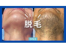 ワン(ONE)の雰囲気（脱毛）