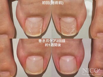 ニコプラス(NICO+)/巻き爪ケア