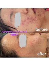 ミア(Mia)/バクテリウピール