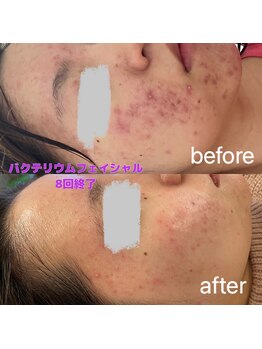 ミア(Mia)/バクテリウピール