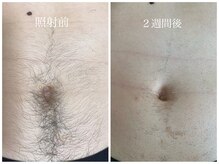 ステラ(STELLA)/お腹脱毛