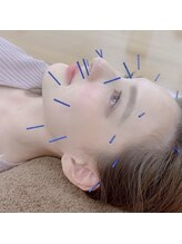 リアン(Re:an)/美容鍼