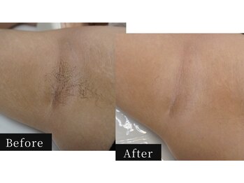 ハル(HAL)/ビフォーアフター/脇脱毛