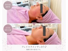 イトウサロン(ITO SALON)/施術1回フェイスラインの変化