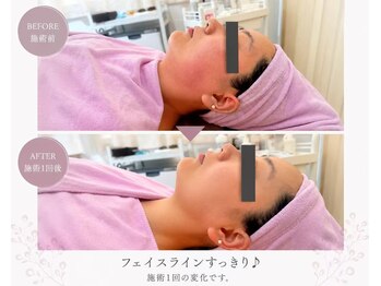 イトウサロン(ITO SALON)/施術1回フェイスラインの変化