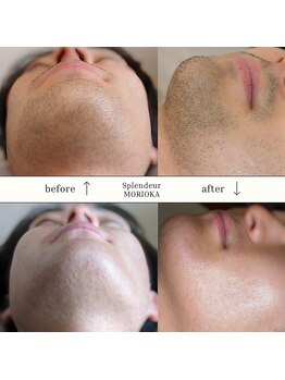 スプランドゥール(Splendeur)/メンズ ヒゲ 光脱毛