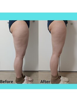 ホワイトビューティーラボ(White Beauty Lab)/足脂肪冷却モニター