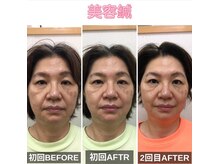 ファミ鍼灸整骨院/小顔矯正【たるみにアプローチ】