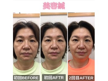 ファミ鍼灸整骨院/小顔矯正【たるみにアプローチ】