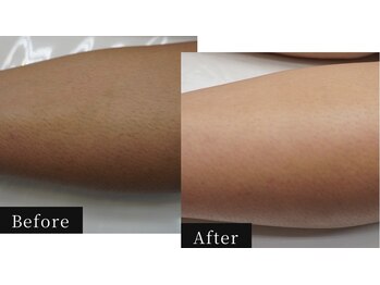 ハル(HAL)/ビフォーアフター/膝下脱毛