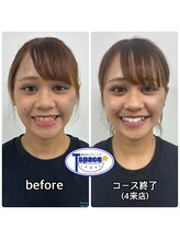 ティースペース 豊田店(T-space)/たった4回でこの変化！